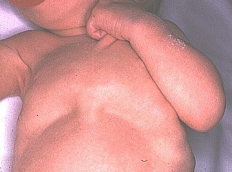 Los bioestimuladores los preparados a la osteocondrosis